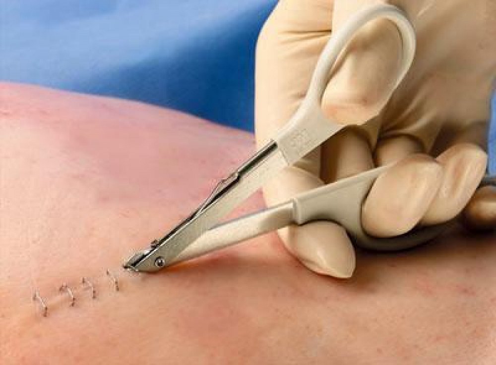 Disposable Surgical Clip Remover