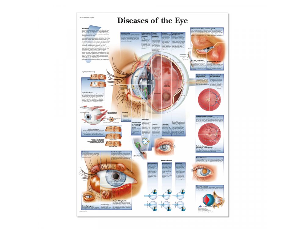 Human eye diseases poster