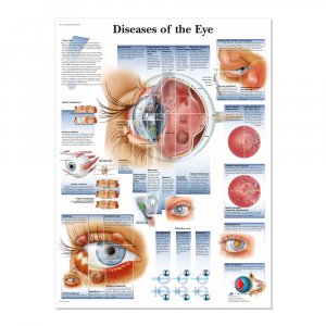 Human eye diseases poster