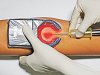 Veinspy Hand-Held Vein Finder