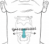 Montgomery Laryngeal Stent – Λαρυγγικός Νάρθηκας