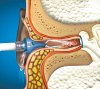 Συσκευή Πλύσης Αυτιών OtoClear Aquabot®